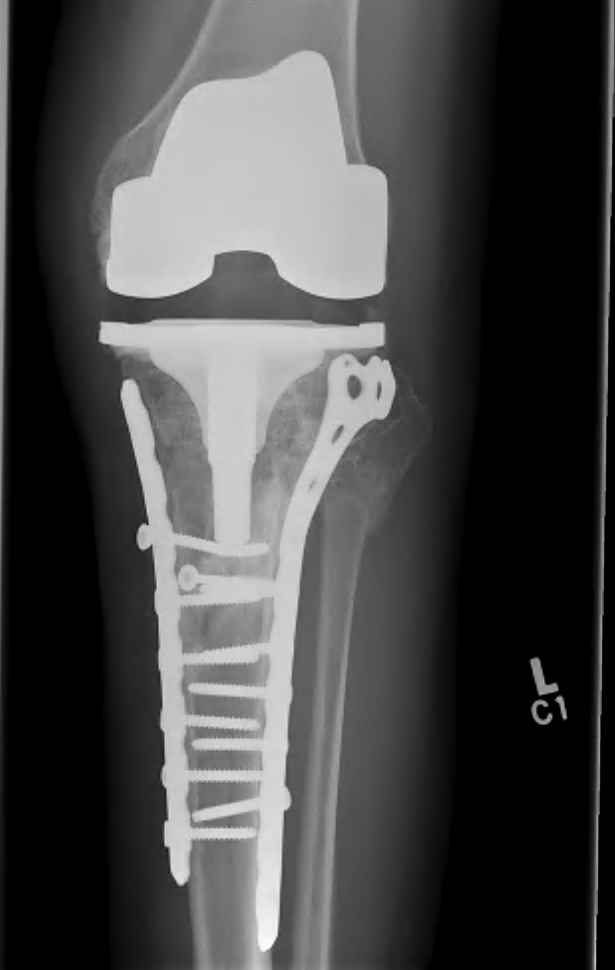 Tibial Plateau OA TKR0002